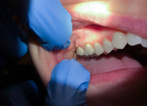 Best Dentist for Tooth Abscess  in Carpendale, WV
