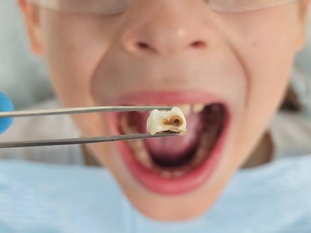 Best Emergency Tooth Extraction  in Carpendale, WV